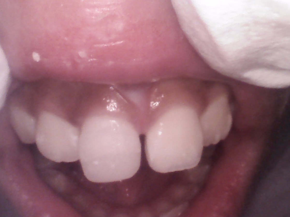 Alignment and gum health result after treatment at Gumdent