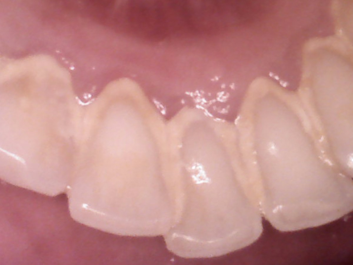 Restorative treatment result after treatment at Gumdent