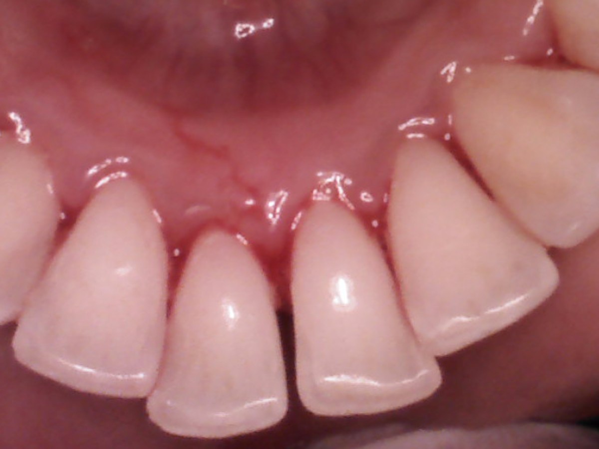 Restorative treatment before treatment at Gumdent