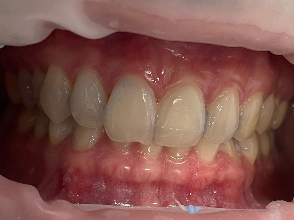 Teeth whitening result after treatment at Gumdent