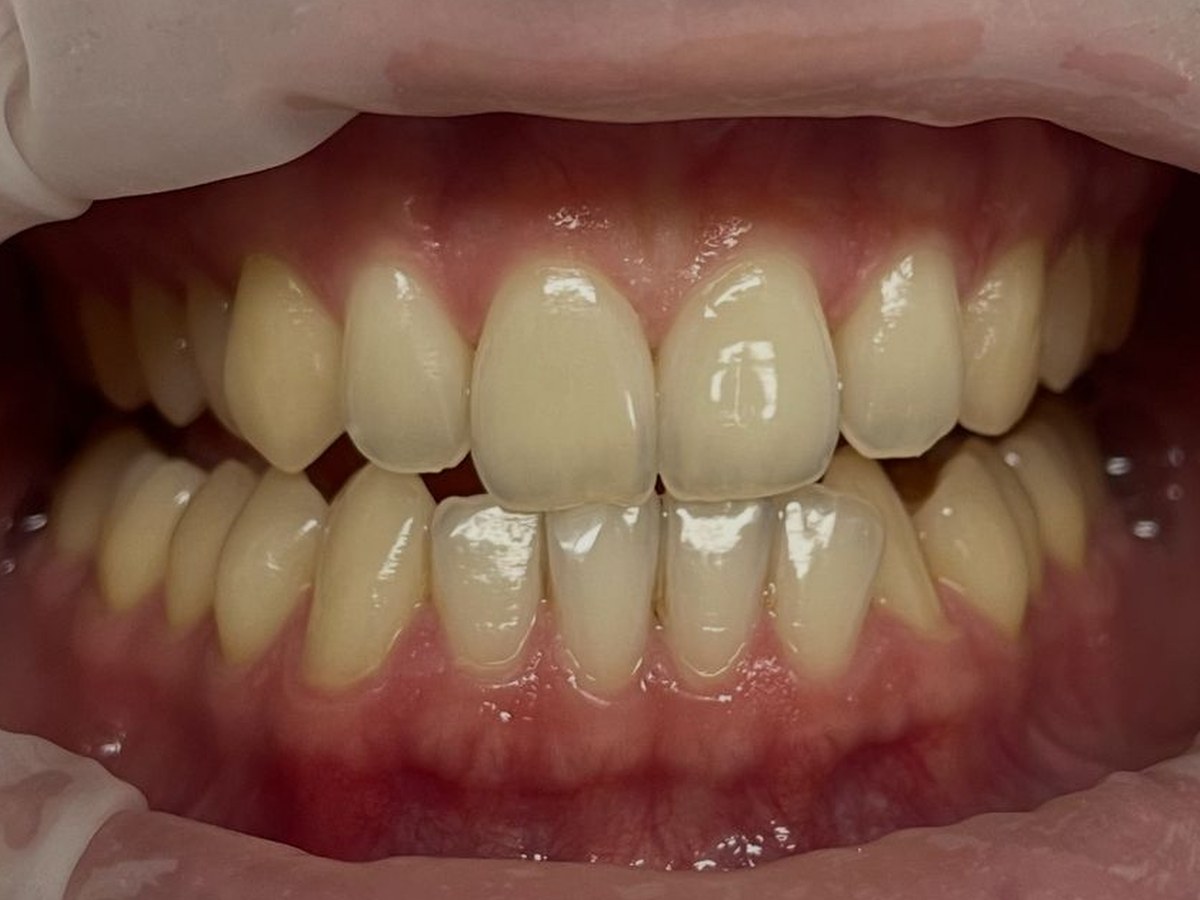 Teeth whitening before treatment at Gumdent